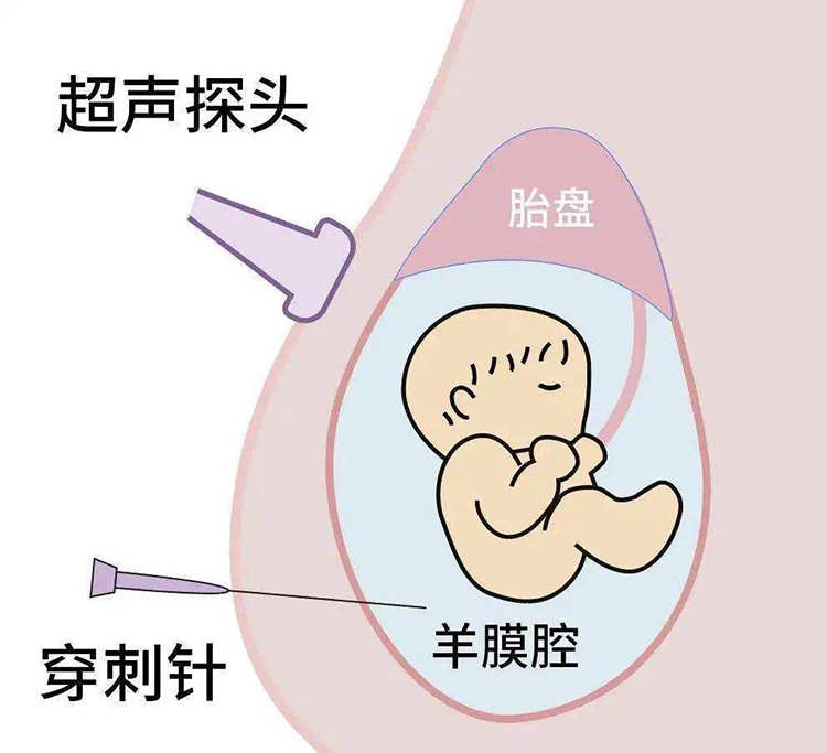 羊水样本采样方法